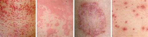 Spots On The Skin Rashes In Patches Causes And Treatment Health