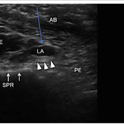 Ultrasound Images Obtained During Femoral Nerve Block Ultrasound Image