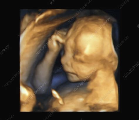 Foetus At 20 Weeks 3d Ultrasound Scan Stock Image C0388813