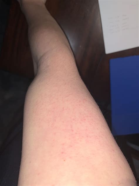 Is This Keratosis Pilaris If So Do You Have Any Educated Tips To Help