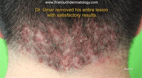 Video Back Of Head Bumps Surgically Cured By Dr U Happy Patient