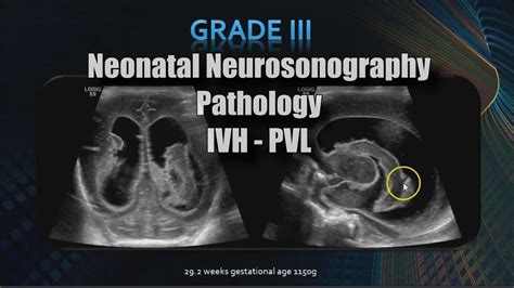 Neonatal Neurosonography Pathology Ivh Pvl Youtube