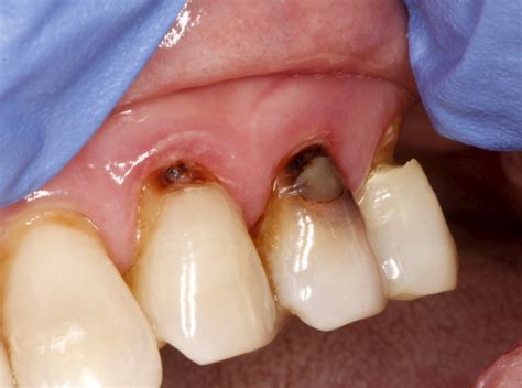 Tooth Decay On The Root Surface Mccarl Dental Group