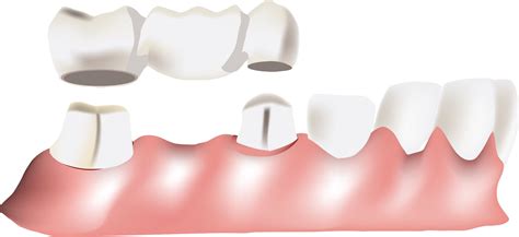 All About Dental Bridges London Dental Implant Dentagama