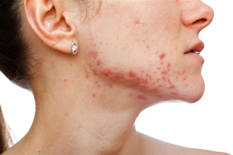 Why Your Acne Wont Go Away And What To Do For Fast Relief Healthdish
