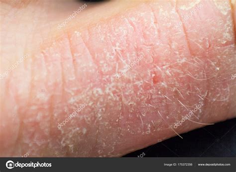 Dermatitis De La Mano Eczema De La Mano — Foto De Stock © D19p76
