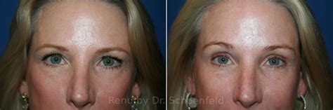 Blepharoplasty Photos Chevy Chase Md Patient 12052