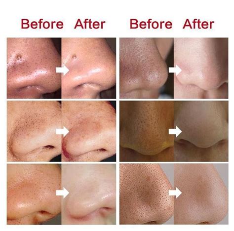 Clogged Exc Excess Oil Pores TIME Clogged Excess Oil Pores
