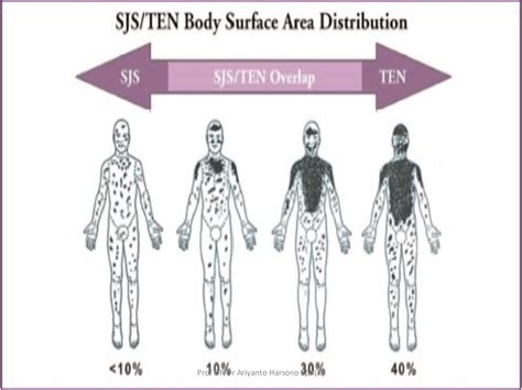 Steven Johnson Syndrome And Ten