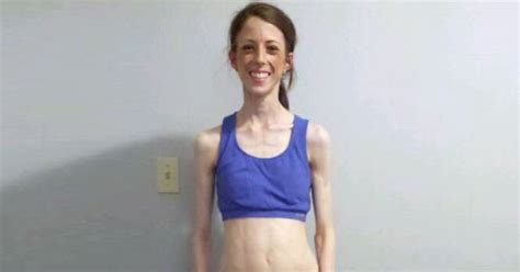 severely anorexic woman s life saved by worried gym goers staging an intervention world news