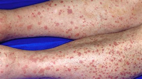 What Causes Red Bumpy Rash On Legs Better Health Channel