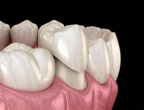 Dental Crowns In Hamilton Faqs Stonehill Dental Hamilton Dentist