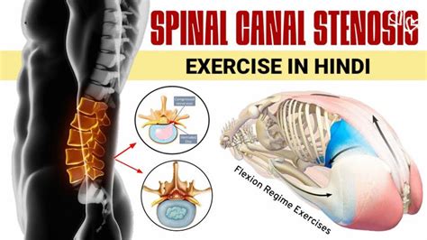 Spinal Canal Stenosis Exercises In Hindi Best Lumbar Canal Stenosis