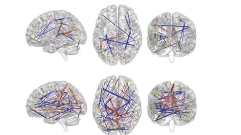 Early Brain Scans Could Predict Likelihood Of Autism Diagnosis — Nova