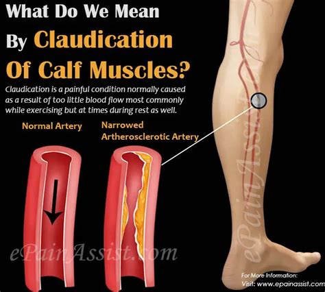 Claudication Of Calf Musclescausessymptomstreatment