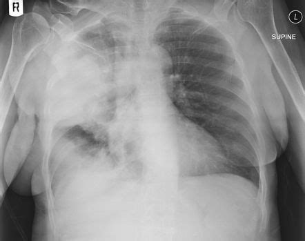 Typical Bacterial Pneumonia Imaging Practice Essentials Radiography