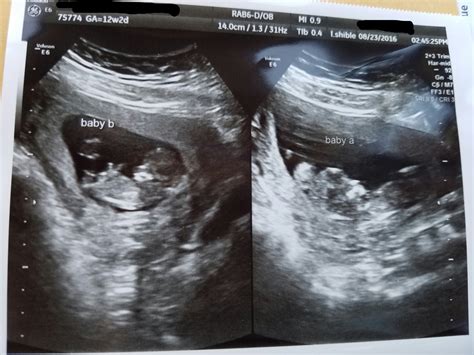 Surprised With Identical Twins At My 12 Week Ultrasound Rbabybumps
