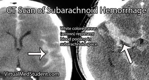 Subarachnoid Hemorrhage Aneurysms Vasospasm And Hyponatremia