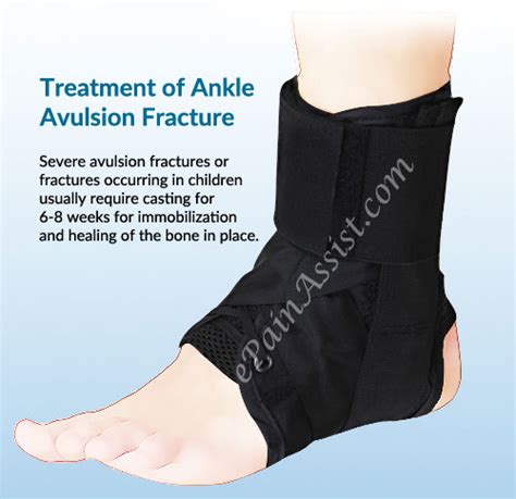 Ankle Avulsion Fracturesymptomscausestreatmentrecovery Timeexercises
