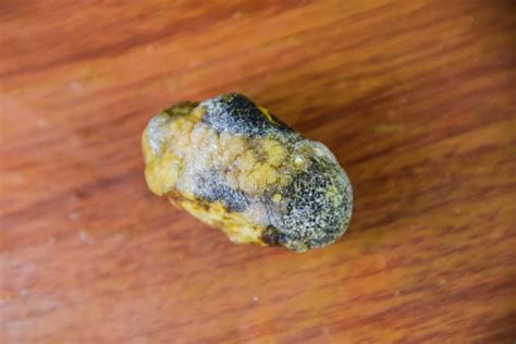 Large Gallstone Gall Bladder Stone The Result Of Gallstones Stock
