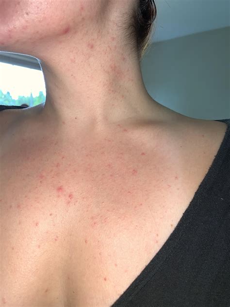 Always Had These Red Bumps On My Chest Appear Every Now And Then Now