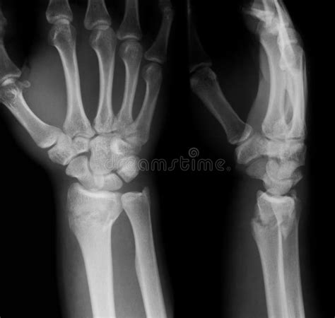 X Ray Image Of Wrist Joint Ap And Lateral View Stock Image Image
