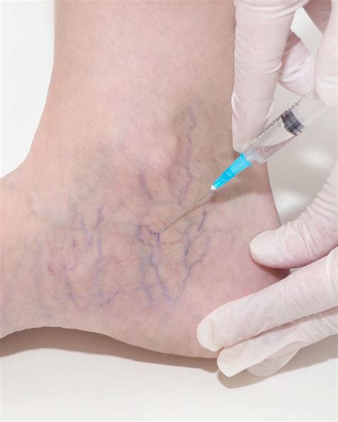 Vein Injection Sclerotherapy Meridian Cosmetic