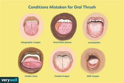 Normal Tongue Vs Oral Thrush And Other Conditions