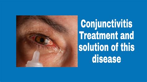 Conjunctivitis Fast Spreading Conjunctivitis Treatment And Solution