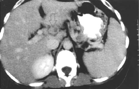 Post Operative Computed Tomography Showing Several Periportal Lymph
