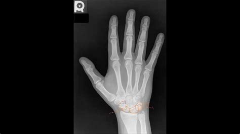 3 View Standard Hand Radiology Tutorial Youtube
