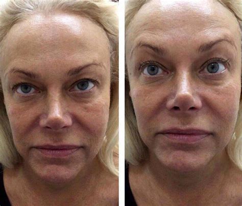 Facelift Hifu Smas Lifting Before And After Facelift Info Prices