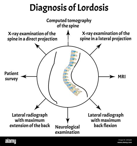 Diagnosis Of Lordosis Spinal Curvature Kyphosis Lordosis Scoliosis