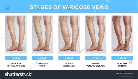 319 Vein Disease Stages Images Stock Photos 3d Objects And Vectors