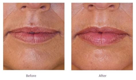 Restylane Lips Before And After Pictures Lipstutorial Org
