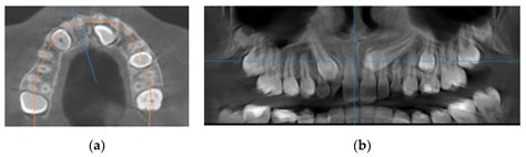 Diagnostics Free Full Text Root Resorptions On Adjacent Teeth