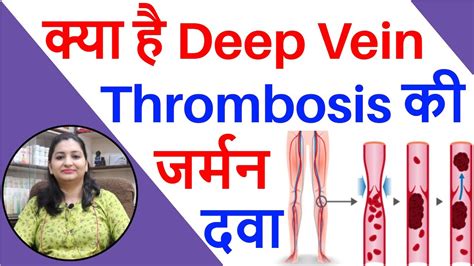 Deep Vein Thrombosis की अचूक दवा Deep Vein Thrombosis Homeopathic