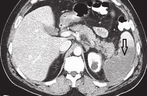 Ct Scan Of The Abdomen Showing Splenic Infarction Indicated With A