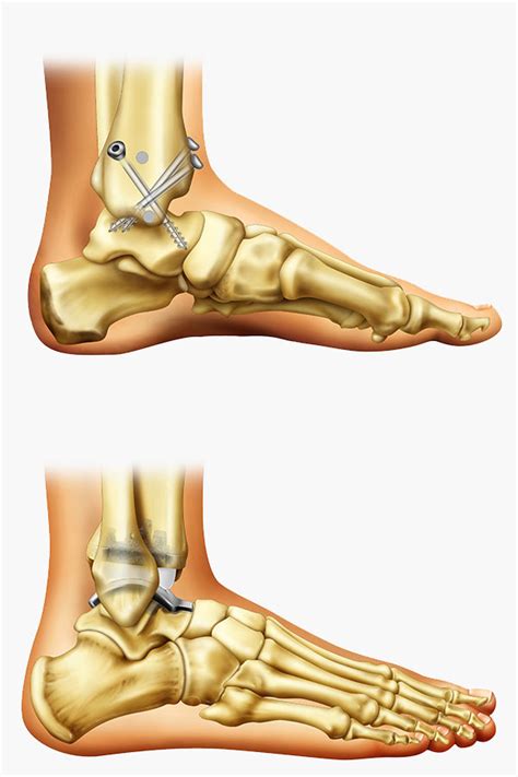 Ankle Replacement Surgery Surgical Treatment Options Exactech