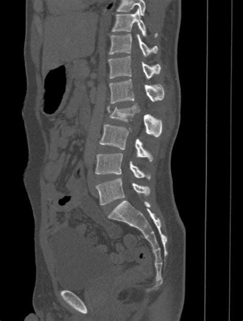 Spinal Cord Compression Ct Wikidoc