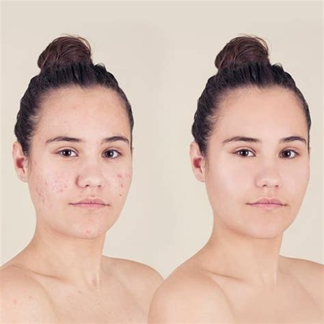 How To Cover Up Acne With Makeup Loréal Paris Acne Concealer Best