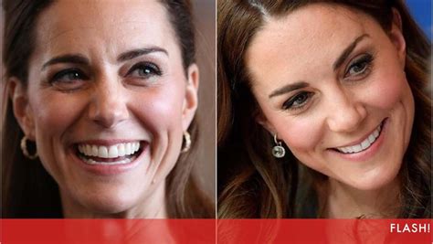 Kate Middleton Já Recorre A Botox Diz Médico Revelando Segredo Da