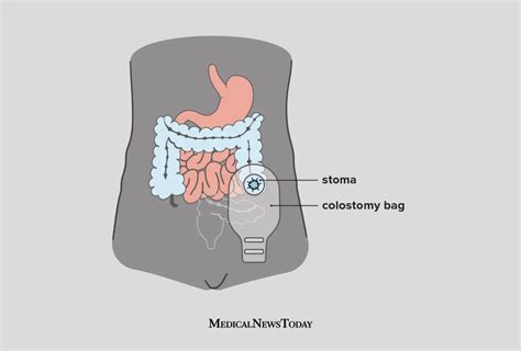 Internal J Pouch