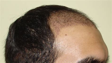 4279 Fuht 4 Weeks Post Op Pictures Hair Transplant Hairsite