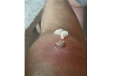 You could develop the bumps regardless of your age provided you shave of wax you thighs. Ingrown Hair Infection On The Upper Knee (With images ...