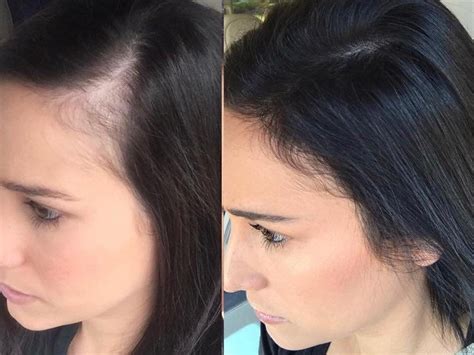 Details More Than Hair Thinning At Front Female Super Hot Ceg Edu Vn