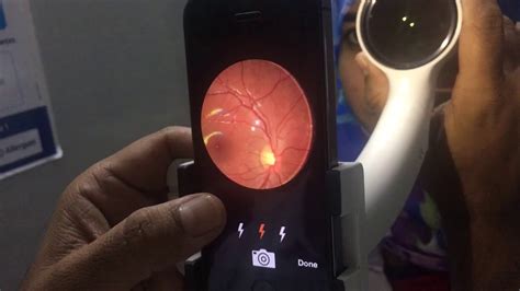Smartphone Fundus Camera Global Sale Inr 19999 Or Usd 380 Youtube