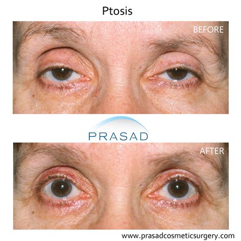 Ptosis Surgery Before And After Photos Amiya Prasad Md Facs