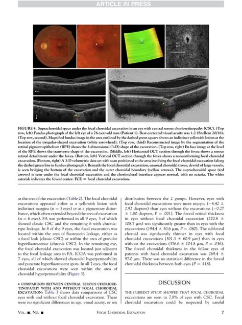 Focal Choroidal Excavation In Eyes With Central Serous Chorioretinopathy