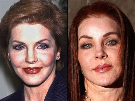 Celebrities Before And After A Plastic Surgery Page 2
